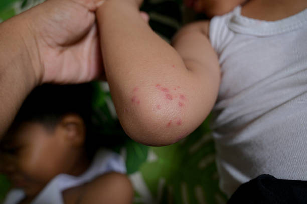 Eczema on Elbows Australia