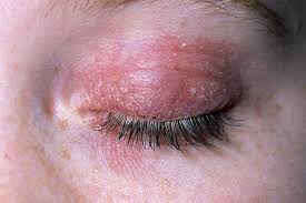 Eczema on Eyelids Australia