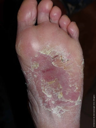 eczema on feet australia