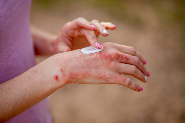 Eczema on Hands Australia