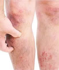 Eczema on Knees Australia