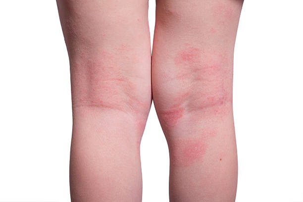 Eczema on Legs Australia