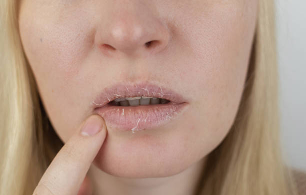 Eczema on Lips Australia