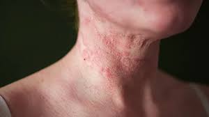 Eczema on Neck Australia