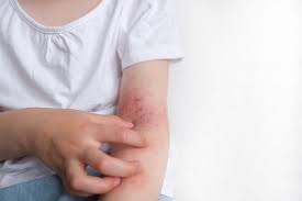 Why Does My Eczema Keep Coming Back