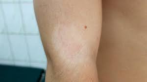 Eczema Scarring Australia