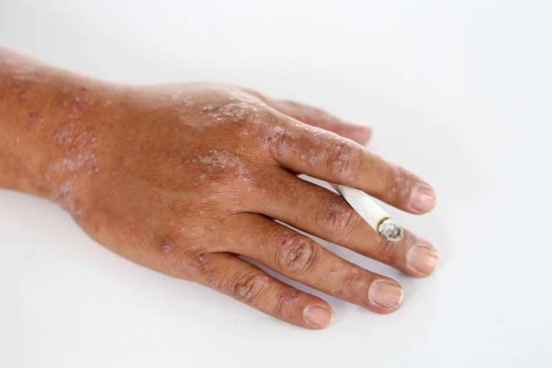 Eczema and Smoking Australia
