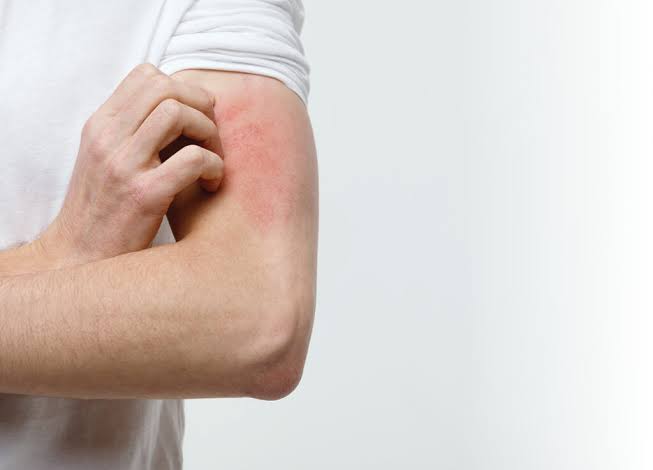 Eczema Flare Triggers Australia