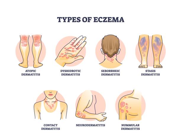 Eczema Types Australia