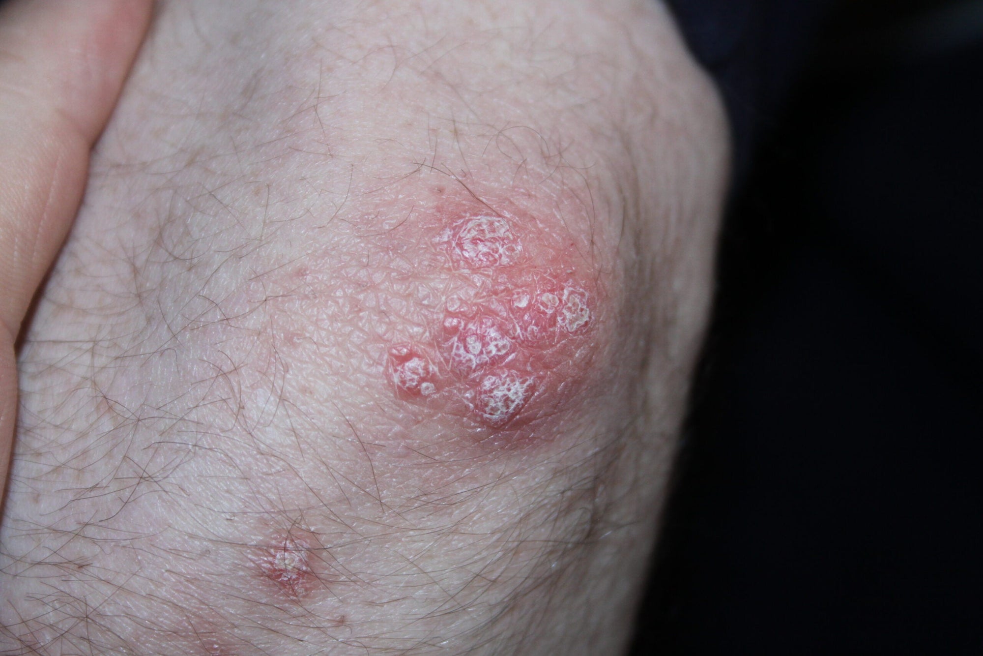 Psoriasis on Elbows Australia