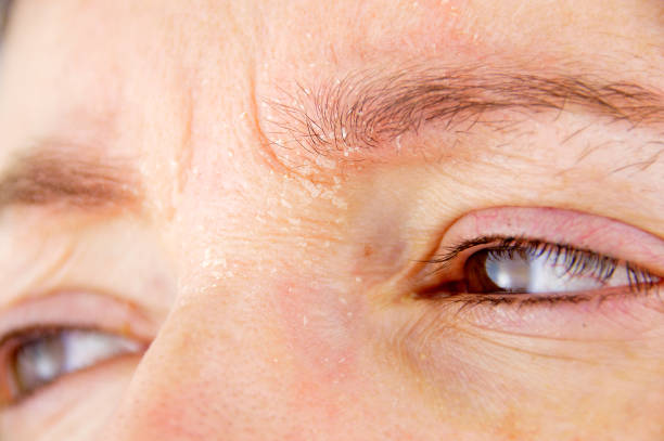 Eyebrow Dandruff