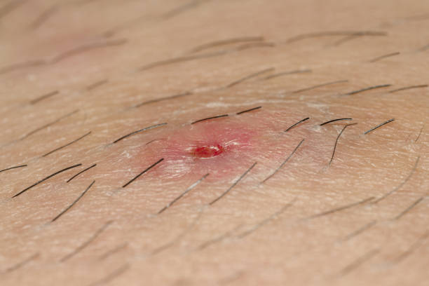 Folliculitis After Shaving Australia
