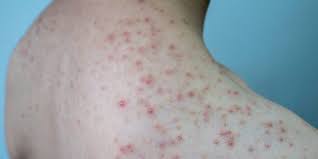 Folliculitis on Chest and Back Australia