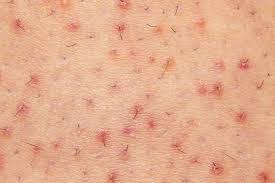 Best Shampoo for Folliculitis Australia