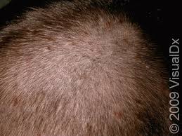What Causes Scalp Folliculitis in Australia