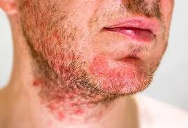Folliculitis on Face Australia