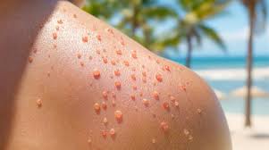 Folliculitis in Summer Australia