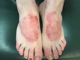 Best Foot Cream for Eczema Australia