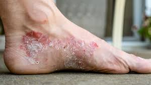 Best Foot Cream for Psoriasis Australia