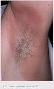Fragrance Allergy Skin Australia