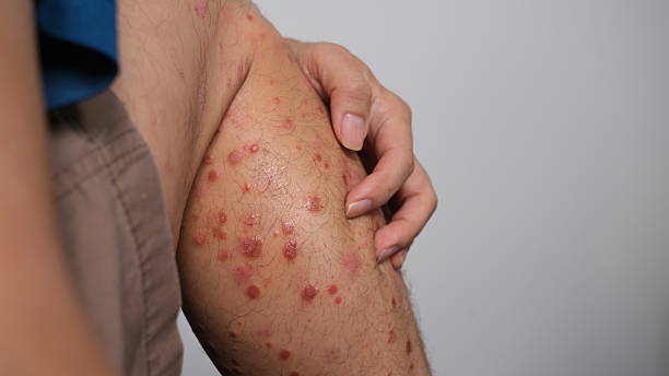  guttate psoriasis 