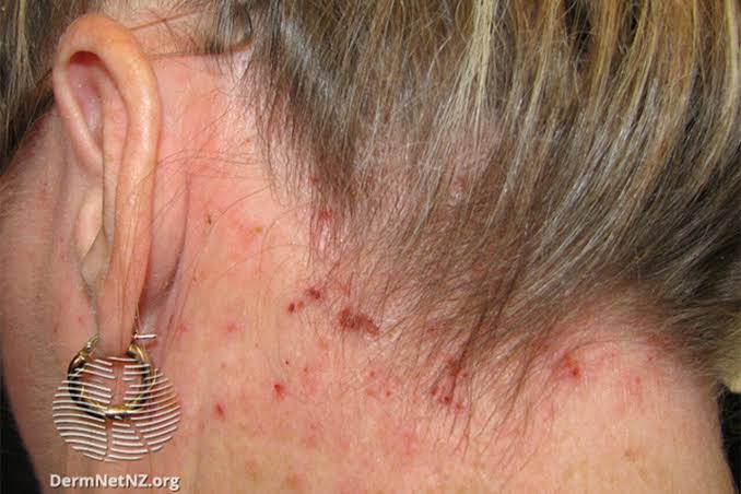 Can Hair Dryers Make Scalp Eczema Worse Australia