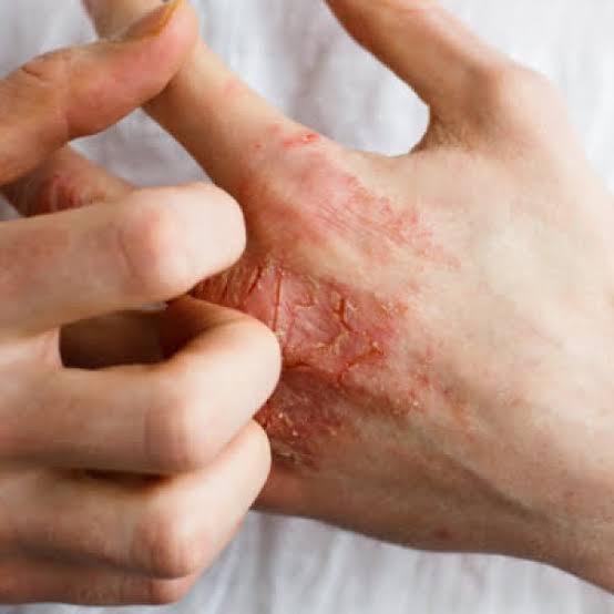 Dermatitis on Hands Australia