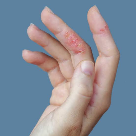 Hand Eczema at Work Australia