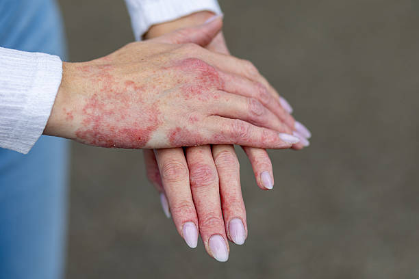 UVB for hands and feet psoriasis Australia