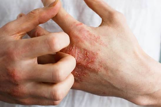 Healthcare Workers and Eczema Australia