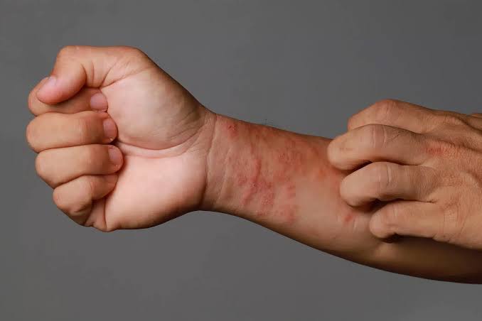 Bee Venom Allergy vs Normal Skin Reaction