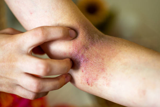 Toddler Eczema Australia