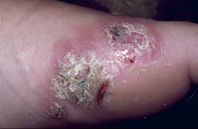 Psoriasis and Infection Australia