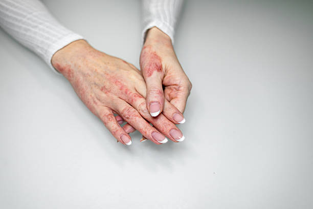 Infected Eczema Australia