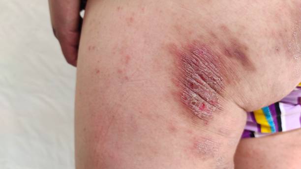 inverse psoriasis australia