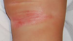 UVB light therapy for inverse psoriasis australia