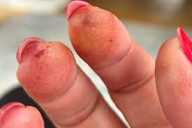 Irritant Contact Dermatitis