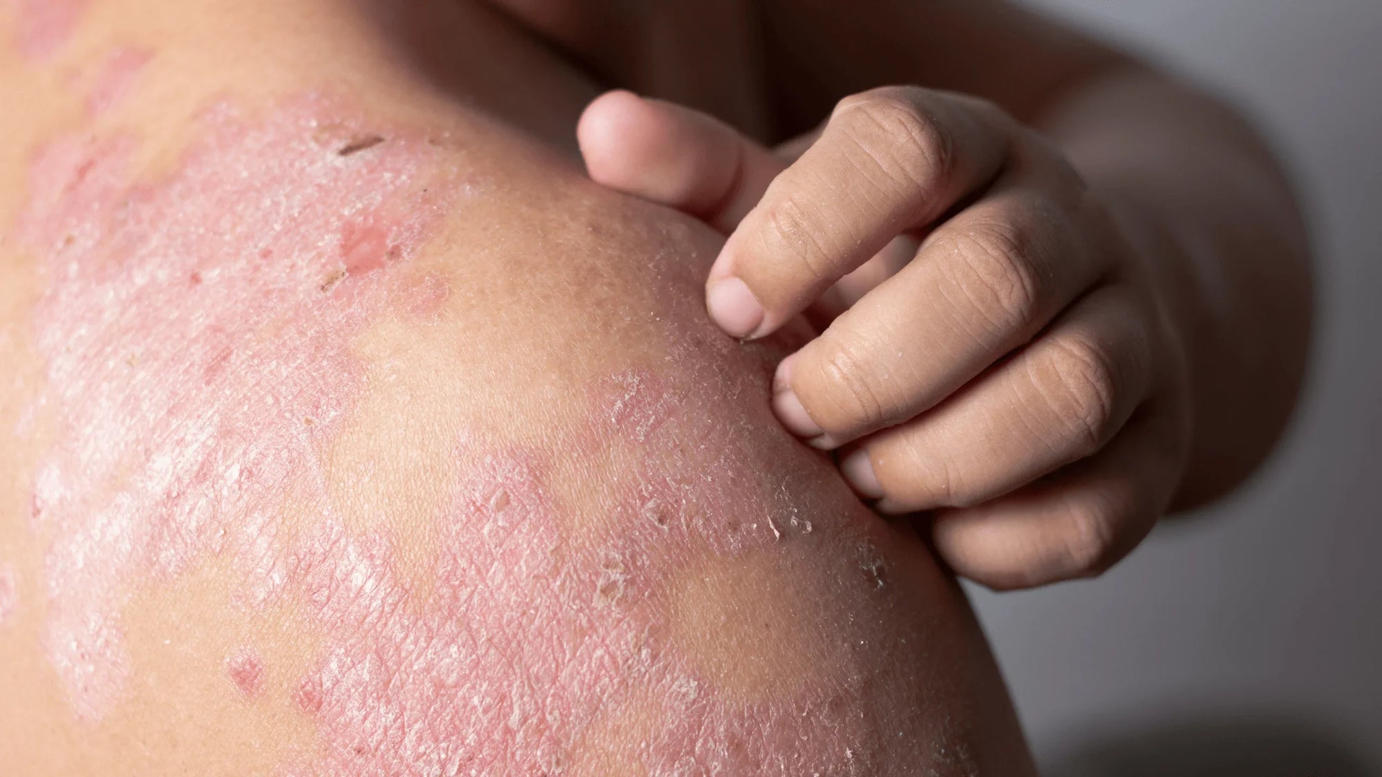 Is Eczema Curable Australia?