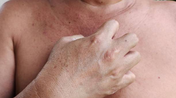 Itchy Chest Australia