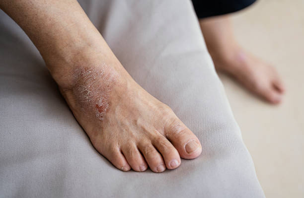 Itchy Feet Causes and Treatment Australia
