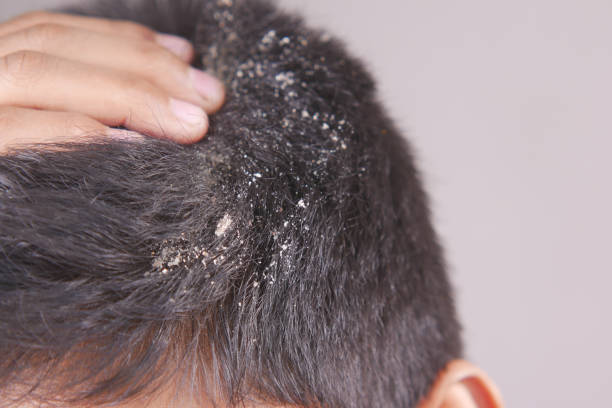 itchy scalp psoriasis treatment