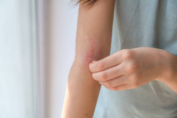 Bee Venom Cream for Itchy Skin