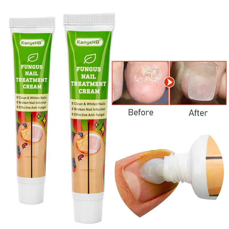 KanyeHB Fungus Nail Treatment Cream Australia