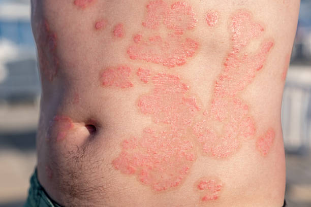 Light Therapy for Psoriasis