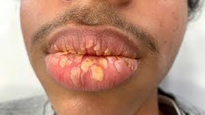 Psoriasis on Lips and Around the Mouth Australia