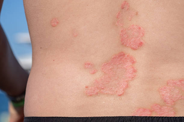 psoriasis on lower back australia
