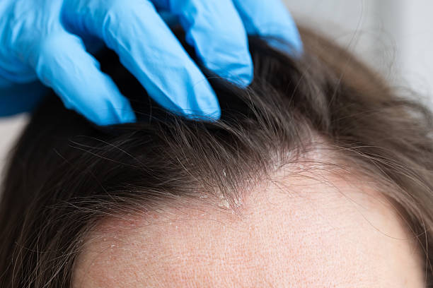 Mild Scalp Psoriasis Australia