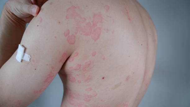 Moderate to Severe Psoriasis Australia