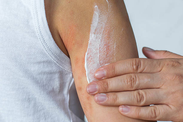 Moisturiser vs Psoriasis Cream
