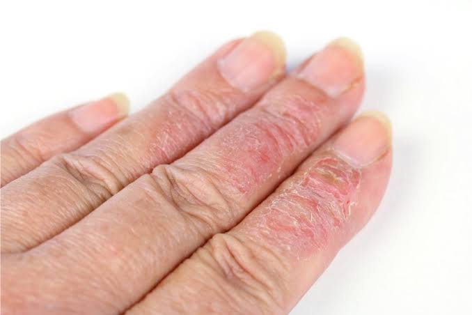 Eczema on Nails Australia